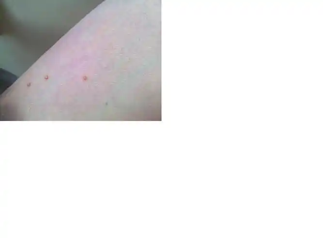 请问阴囊上和大腿根部长了几个白色的小疙瘩 有3-4个月了,请问是怎么