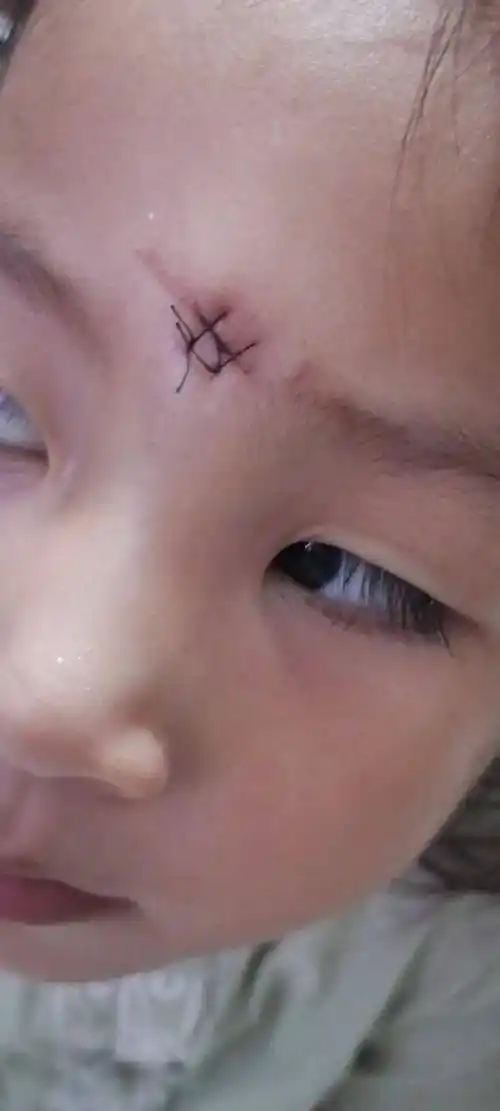 幼儿在园受伤_幼儿在园受伤如何与家长沟通