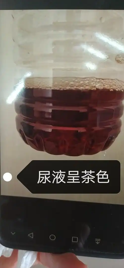 开学季军训季应警惕横纹肌溶解症