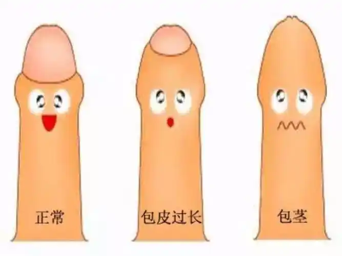 临近暑假,又到了男孩儿扎堆割包皮的季节了!