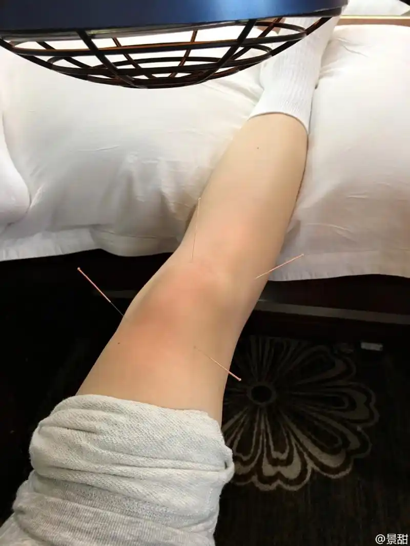 组图:景甜拍打戏落下后遗症 靠针灸理疗缓解_高清图集_新浪网