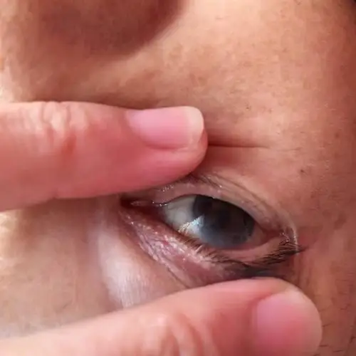 眼部微循环缓慢,毒素容易淤堵,形成干眼症及哇鸣现象