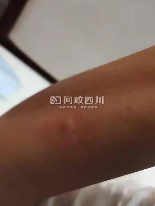 隔离酒店房间潮湿,床上有床虱,晚上咬得人无法入睡,小孩也被咬一身.