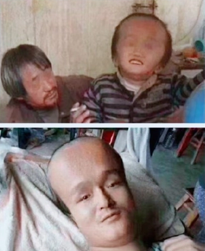 喝过三鹿奶粉的孩子,因为里面的三聚氰胺,在发育过程中变成了大头娃娃