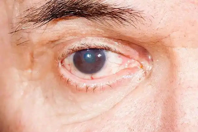 新冠眼睛模糊吗多久恢复正常,新冠眼睛模糊吗多久恢复正常视力