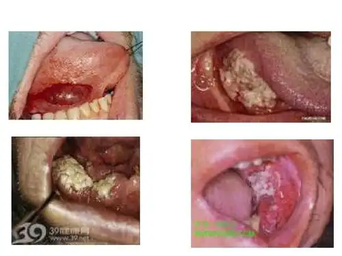 颌面部肿瘤图片(2)ppt