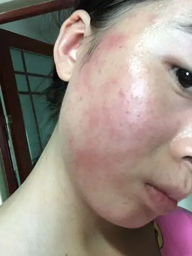 因为有乙肝,喝了一个月中药,刚开始只是红,喝到26天的时候就长了这些