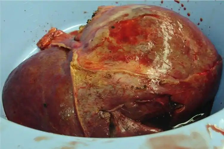 酒精肝的真实图片