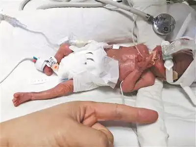 出生时月月体重540克,只有成人巴掌大.