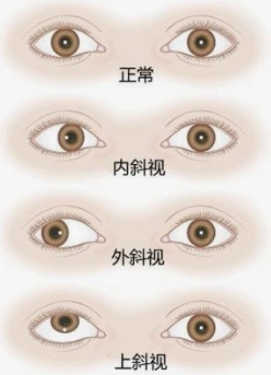 积医科普影响颜值更影响健康专家说斜视治疗要趁早