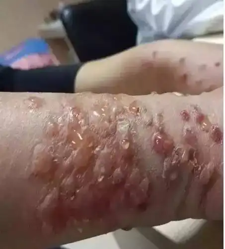 太可怕了!五一出游遇到这种"小黑虫"千万别拍死,否则后果非常可怕