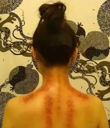 背部刮痧,可以看出一个人的身体健康状况!