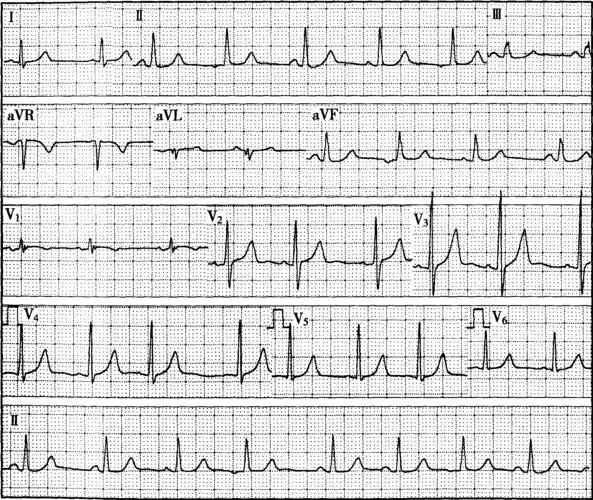 【心电图表现】  p波:规律发生,律整,p-p间距0.
