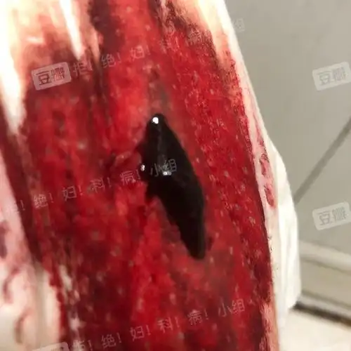 姨妈血一直流血块是什么原因!有图慎入