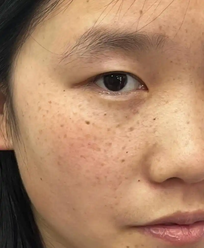 色素斑,是指皮肤表面出现的一种色素沉着的病变.