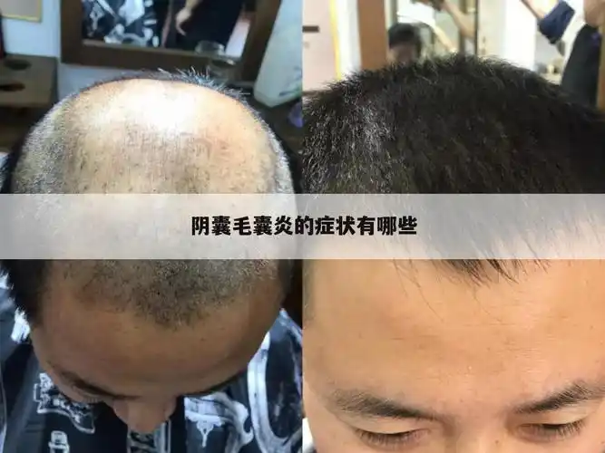 阴囊毛囊炎的症状有哪些