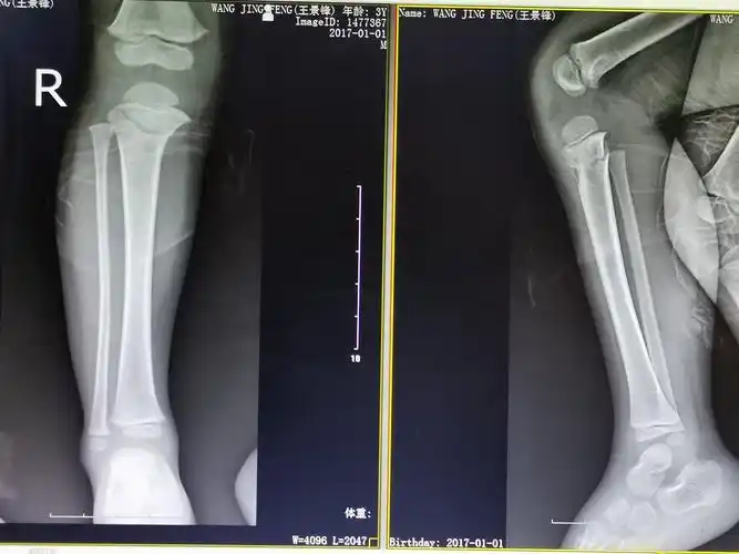 儿童胫骨近端骨折非手术治疗