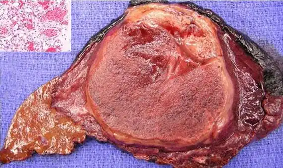 图解7种常见肝脏肿瘤—良性篇 - 好大夫在线