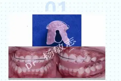 孩子下巴有点后缩的早期矫治相关问题解答
