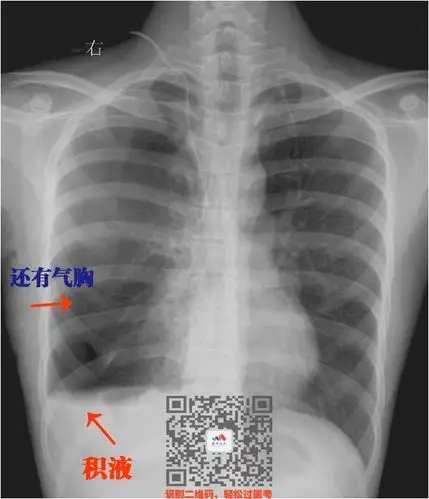 胸腔积液4大天王!