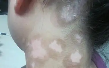 各种皮肤病一直处于高发期,近日有些家长发现宝宝的脖子上长了些白点