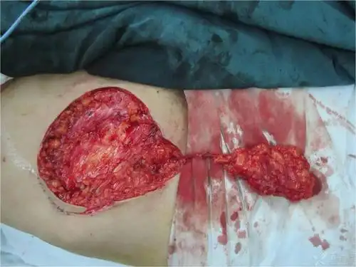 患者女性,17岁,左足外伤术后皮肤软组织坏死缺损,创面内肌腱外露.