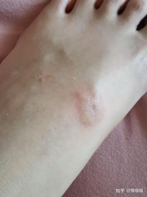 我不知道被什么虫子咬了脚踝很痒出现了红色的肿块中间还有个透明凸起