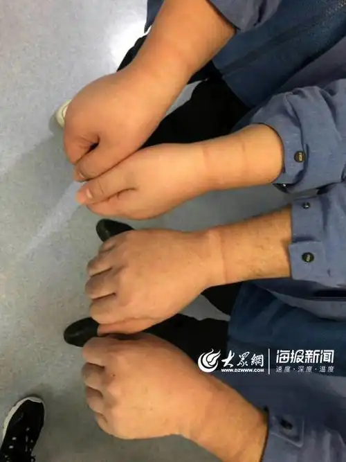 「疫线故事」勒痕与压疮,是战"疫"中最珍贵的勋章