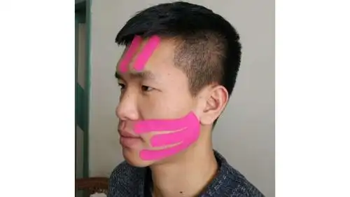 得了面瘫别苦恼,锦医大一院康复科里有绝招