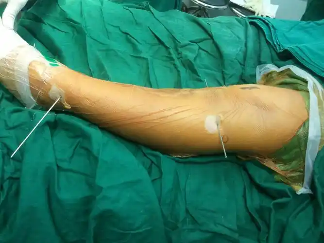 下肢畸形, o型腿,x型腿,长短腿, 优美协调的腿 - 好大夫在线