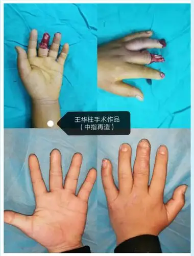 不久前,王华柱副主任通过电话与他们取得联系,他们对手术的结果很满意