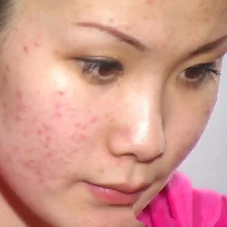 最严重的痤疮图片