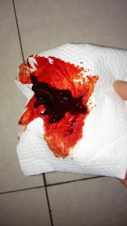 期间每次都有这样的血块来月经有血块吃什么好月经流出来的血块图片