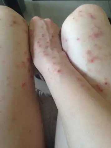 被狗狗身上的虱子咬了,浑身全是红点瘙痒难耐,看了好多医生都没治好!