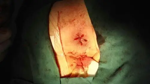 痔疮前后对比微创源于手术艺术