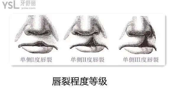 轻微的兔唇是什么样子 不做手术可以长好吗