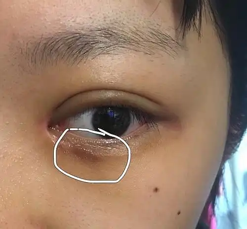 求助!一个月多!眼角下面总是黑黑的!不知道是什么