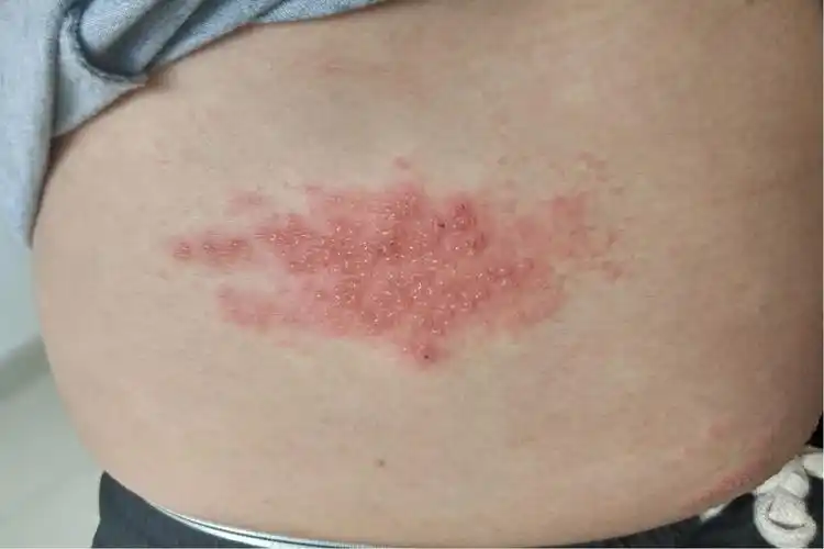 男性腰部疱疹图