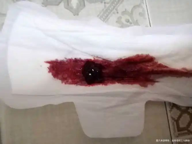 为什么做完造影后一个月来月经了月经上有很大一