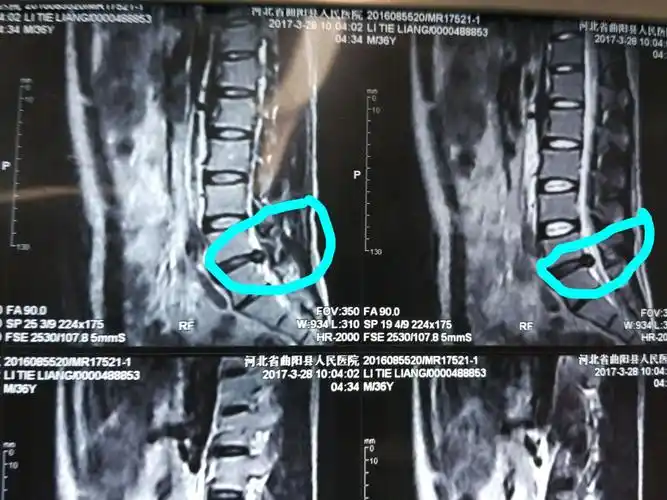 病人术前片子,腰五骶一椎间盘突出.