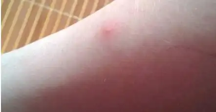 虱子咬后的症状图片