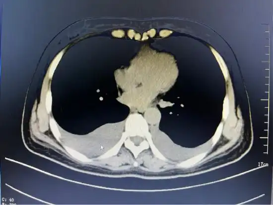 术前胸部ct示胸腔积液