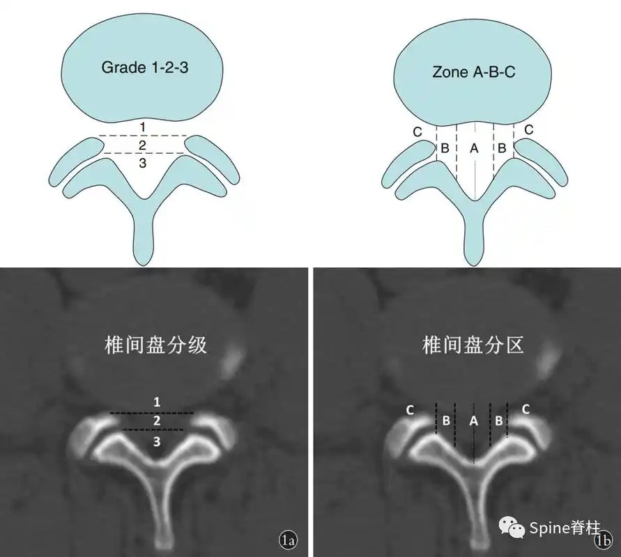 他们基于腰椎间盘突出的msu分级分区,在ct上定义微小腰椎间盘突出为