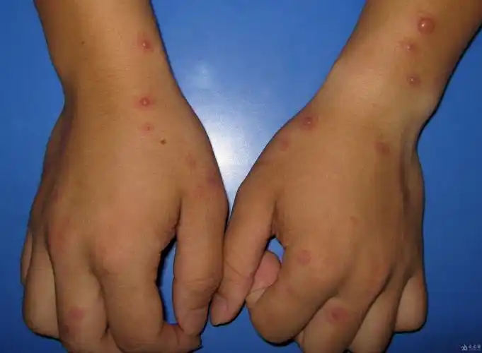 常见手部皮肤病8例