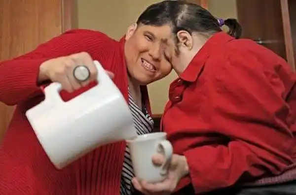 世界各地的连体人