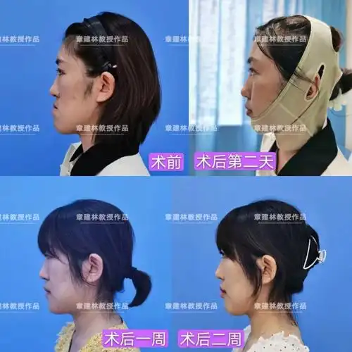 地包天 #正颌_正颌手术_地包天_美妆_医美整形