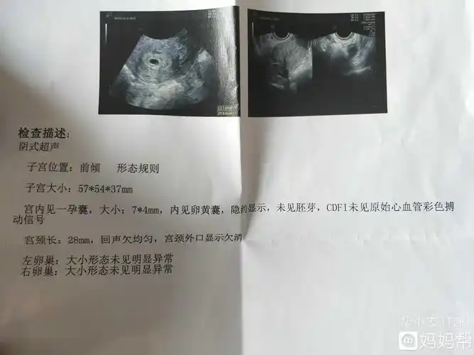 棒!怀孕45天孕囊大小"给你支招"-第2张图片-瑞普博客