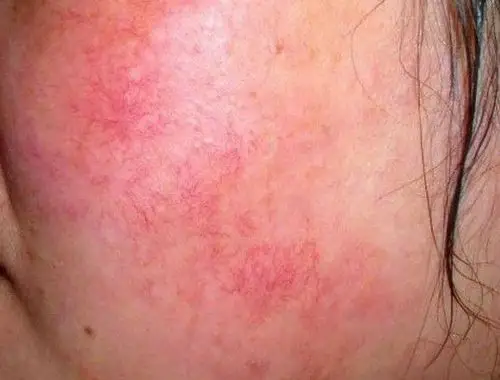 其它 敏感性肌肤 写美篇敏感肌肤的表现