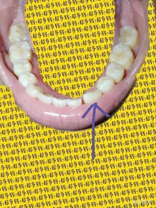 正常人有28颗牙齿,我只有26颗,为什么呢?