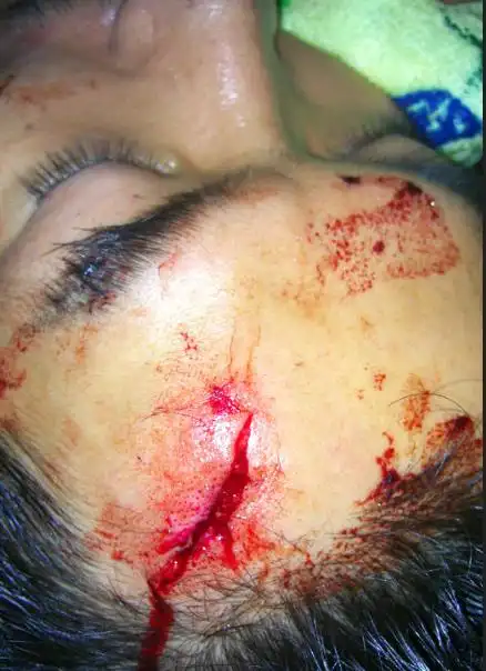 内地男星拍戏意外受伤昏迷 伤势或致其毁容